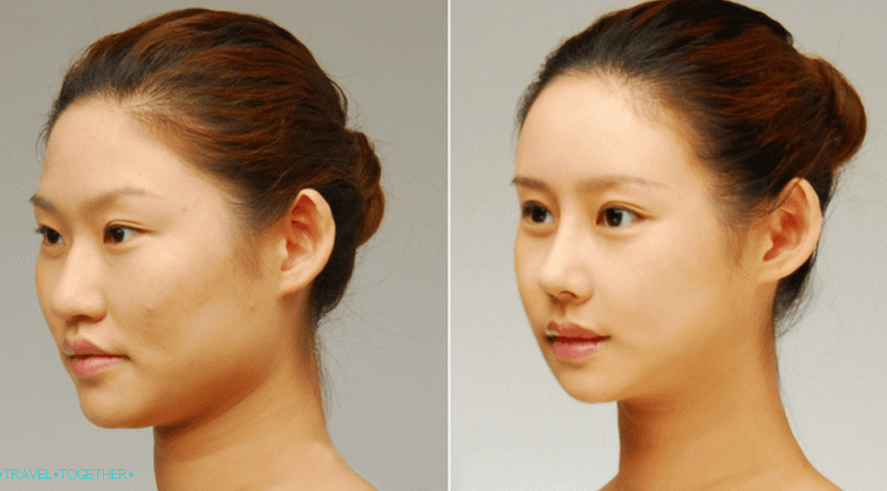 Blefaroplastika u Tajlandu